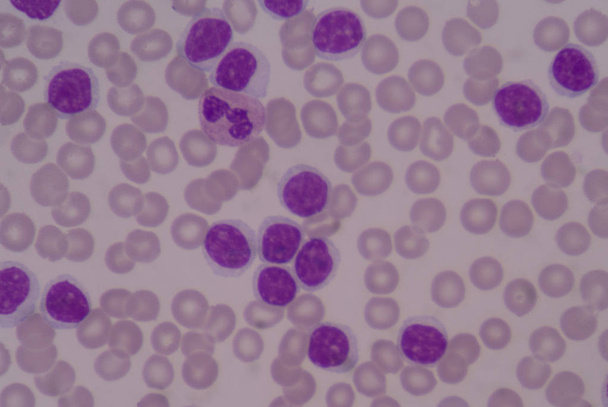 Moderatr blast cellen op rode bloedcellen background.medical concept. - Foto, afbeelding