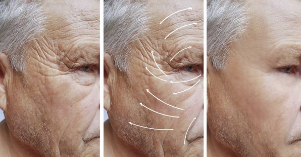 ο άνθρωπος, τις ρυτίδες στο πρόσωπο, διόρθωση πριν και μετά από διαδικασίες, βέλος - Φωτογραφία, εικόνα