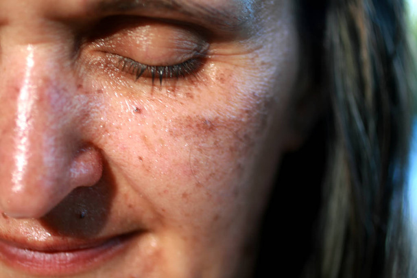 Pigmented spots on the face. Pigmentation on cheeks - Photo, Image