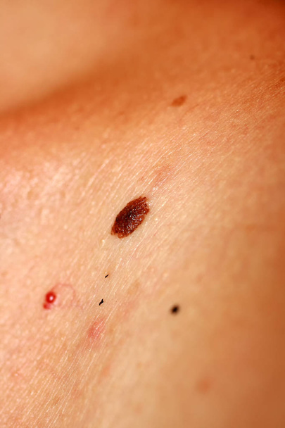 Brown birthmark. Brown mole large size. Stain on the skin - Photo, Image