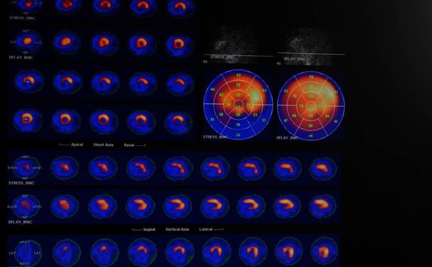 Resonancia magnética del corazón y los vasos coronarios con líquido de contraste y estrés
 - Foto, Imagen