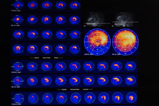 MRT del cuore e dei vasi coronarici utilizzando fluido di contrasto e stress
 - Foto, immagini