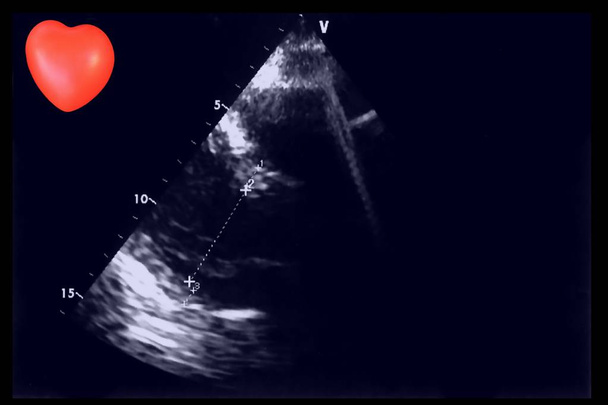 Cardiac ultrasound images and small heart . Screen of echo-cardiography machine. Doppler echo - Photo, Image