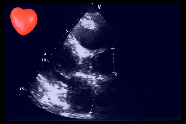 Herz-Ultraschall-Bilder und kleine Herzen. Bildschirm der Echokardiographie-Maschine. doppeltes Echo - Foto, Bild
