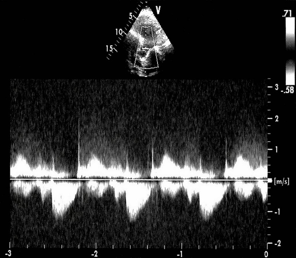 Cardiac ultrasound images . Screen of echo-cardiography machine. Doppler echo - Photo, Image