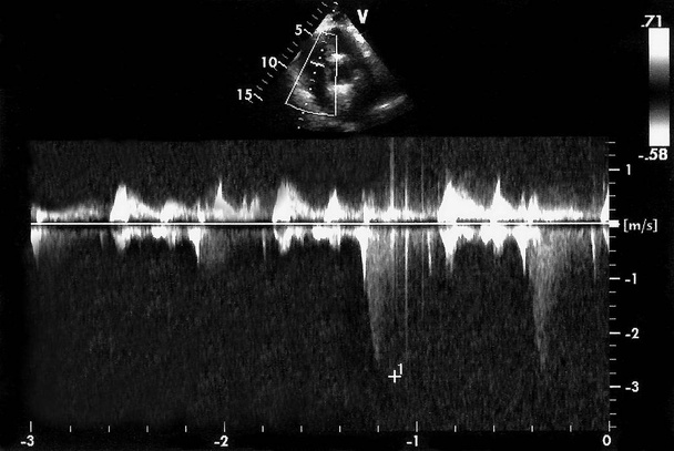 Imagens de ultrassom cardíaco. Tela da máquina de ecocardiografia. Ecodoppler
 - Foto, Imagem