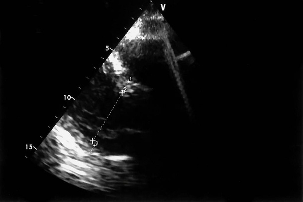 Imágenes de ultrasonido cardíaco. Pantalla de la máquina de ecocardiografía. Ecografía Doppler
 - Foto, Imagen
