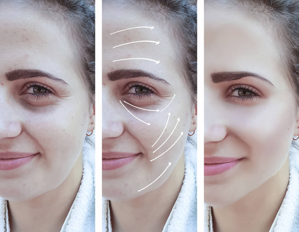 Kobieta twarzy zmarszczki korekty przed i po procedur strzałka - Zdjęcie, obraz