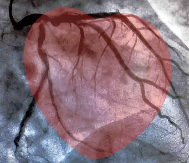 Катетеризація і маленьке червоне серце. Серцевий шлуночок це медичний тест, який використовується для визначення функції серця пацієнта в правому або лівому шлуночках
 - Фото, зображення