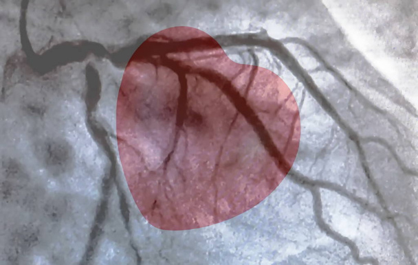 Cateterismo e pequeno coração vermelho. A ventriculografia cardíaca é um exame de imagem médica usado para determinar a função cardíaca do paciente no ventrículo direito ou esquerdo.
 - Foto, Imagem