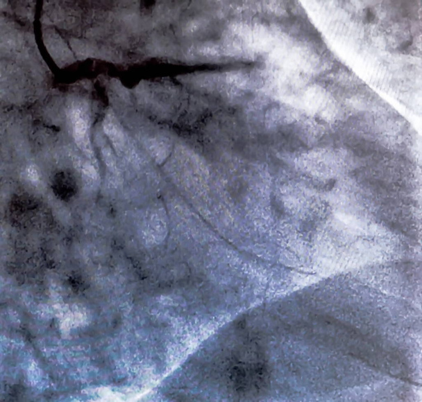 Catheterisatie. Cardiale ventriculography is een medische beeldvorming test gebruikt om te bepalen een patiënt hartfunctie in het ventrikel rechts of links - Foto, afbeelding