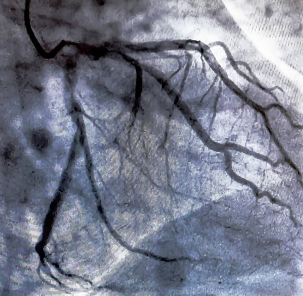 Katéterezés. Szív ventriculographia egy orvosi képalkotó vizsgálat segítségével meghatározható egy beteg szív a jobb vagy bal kamra funkció - Fotó, kép