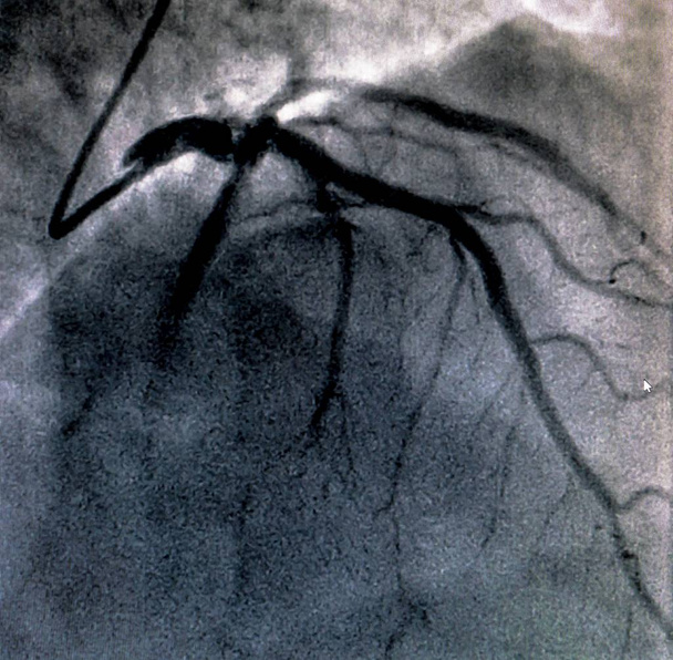 カテーテル検査。心臓造影は右または左心室における患者の心機能を決定するために使用するイメージング検査です。 - 写真・画像
