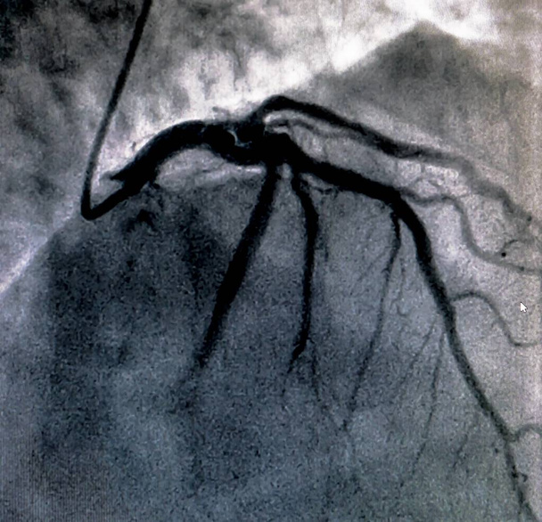 Cateterismo. La ventriculografía cardiaca es una prueba de imagen médica utilizada para determinar la función cardiaca de un paciente en el ventrículo derecho o izquierdo.
 - Foto, imagen