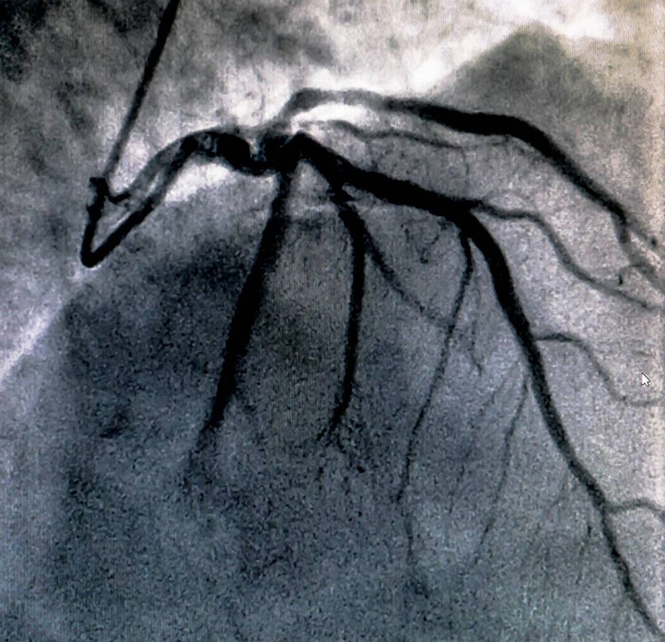 Καθετηριασμό. Καρδιακή κοιλιογραφία είναι μια ιατρική εξέταση απεικόνισης που χρησιμοποιείται για τον προσδιορισμό ενός ασθενούς καρδιακή λειτουργία στη δεξιά ή αριστερή κοιλία - Φωτογραφία, εικόνα