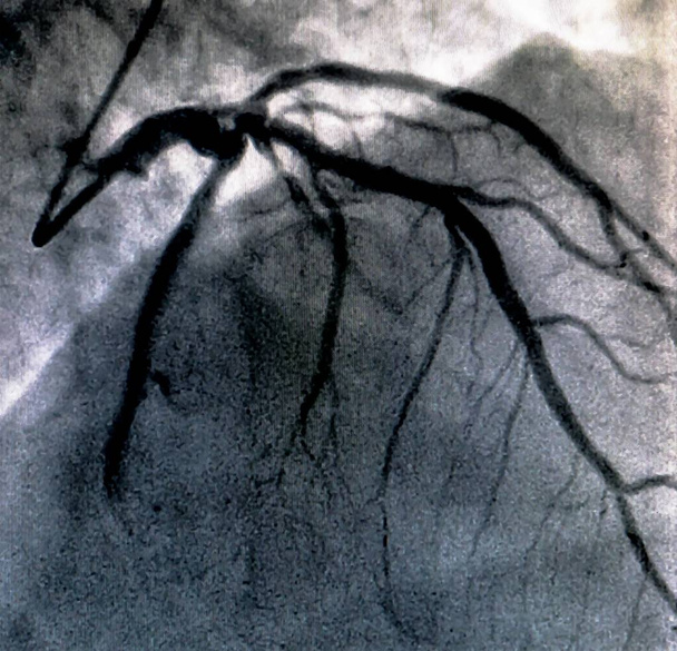 Katéterezés. Szív ventriculographia egy orvosi képalkotó vizsgálat segítségével meghatározható egy beteg szív a jobb vagy bal kamra funkció - Fotó, kép