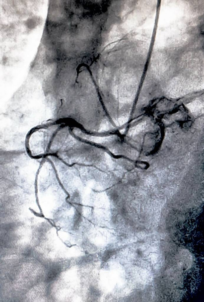 Catheterisatie. Cardiale ventriculography is een medische beeldvorming test gebruikt om te bepalen een patiënt hartfunctie in het ventrikel rechts of links - Foto, afbeelding