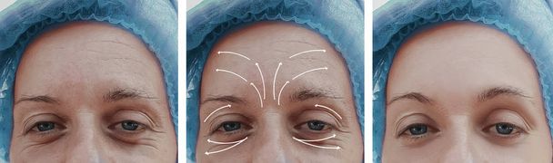 mulher rosto rugas correção antes e depois dos procedimentos, seta
 - Foto, Imagem