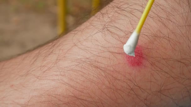 Uszkodzenia jasne siniak na nodze człowieka - Materiał filmowy, wideo