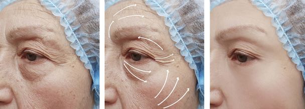 Starsza kobieta zmarszczki twarzy przed i po Korekcja procedur - Zdjęcie, obraz