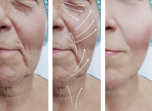 高齢者の女性の顔のしわ補正の手順の前後に - 写真・画像