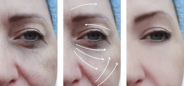 Frauenfalten im Gesicht vor und nach Korrekturmaßnahmen - Foto, Bild