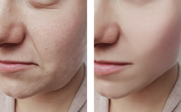 женские морщины до и после процедур
 - Фото, изображение
