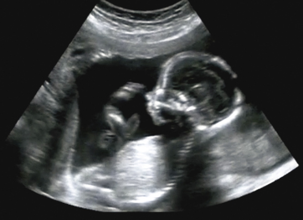 最初の月の産科超音波検査超音波診断法 - 写真・画像