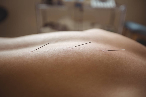 Close-up do paciente recebendo agulhas secas nas costas
 - Foto, Imagem