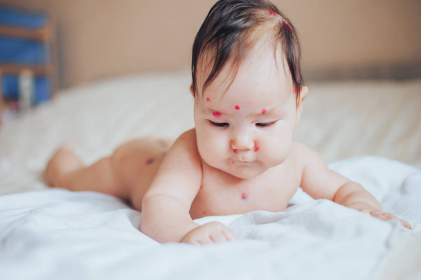 Close-up of naked body of child with pimples of chicken pox. pimples on the body of child with chickenpox - Photo, Image