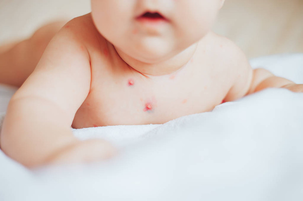 Close-up of naked body of child with pimples of chicken pox. pimples on the body of child with chickenpox - Photo, Image