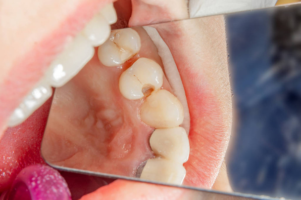 Carie dentaria. Riempimento con materiale fotopolimero composito dentale utilizzando rabbini. Il concetto di trattamento dentale in una clinica dentistica
 - Foto, immagini