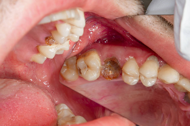 Cárie dentária. Enchimento com material de fotopolímero composto dental usando coelhos. O conceito de tratamento odontológico em uma clínica odontológica
 - Foto, Imagem