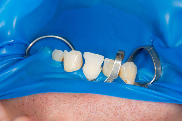 Tandcariës. Vullen met tandheelkundige composiet fotopolymeer materiaal met behulp van rabbders. Het concept van tandheelkundige behandeling in een tandheelkundige kliniek - Foto, afbeelding