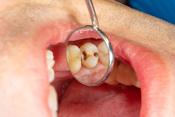 2 つの齲蝕の治療後上顎の側の歯を噛みます。充填材ラバーダムを用いたフォトポリマーにかみ砕く表面の復元 - 写真・画像