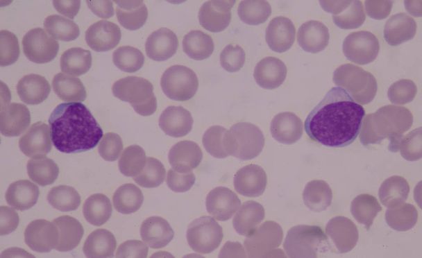 Blast cellen op rode bloedcellen achtergrond medische. - Foto, afbeelding