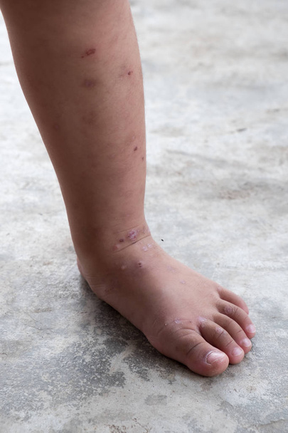 Dermatitis punzante pie de bebé atópico. Herida infectada.Herida abierta en la pierna izquierda
. - Foto, imagen