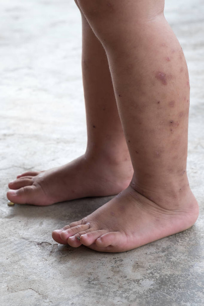 かゆみを伴う皮膚炎アトピー赤ちゃんの足。感染創を閉じます。左脚に傷を開く. - 写真・画像