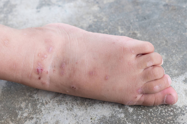 Атопическая детская нога зудящего дерматита. Закрыть заражённую рану. Открыть рану на левой ноге.
. - Фото, изображение