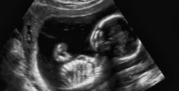 Υπερηχογραφία Ανάλυση 4ου Μήνα Έμβρυου, Ιταλία - Φωτογραφία, εικόνα