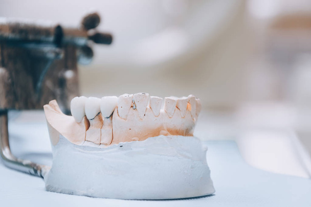 Gesso Mascelle umane stomatologiche. Corona in ceramica-metallo sul modello in gesso su fondo sfocato dello studio dentistico. Tonalità bianca
 - Foto, immagini