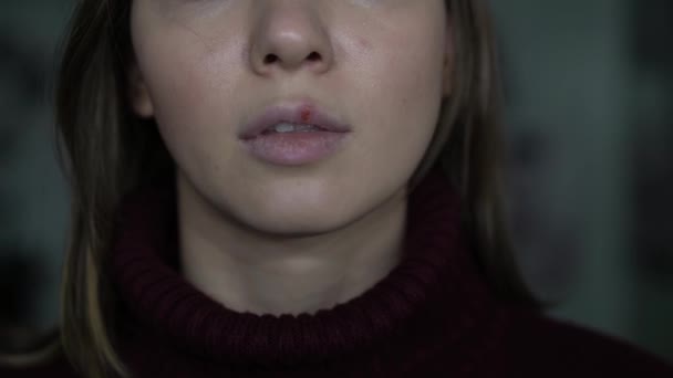 herpes on the lips, part of a womans face with finger on lips with herpes, beauty concept - Materiał filmowy, wideo