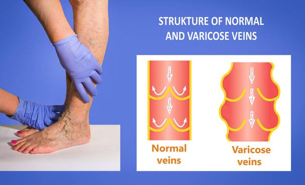 Venas varicosas en las piernas de una mujer mayor. La estructura de las venas normales y varicosas - Foto, Imagen