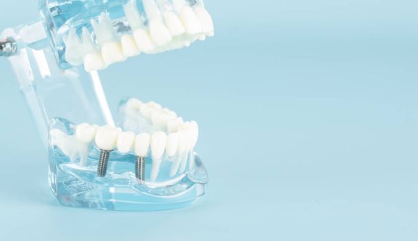Dental model in oral health care concept. - Фото, изображение