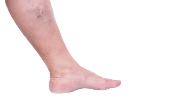 Leg of an elderly woman on a white background with varicose veins, close-up, isolate, phlebeurysm and thrombophlebitis, problem - Fotó, kép