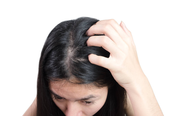 women head with dandruff Caused by the problem of dirty. Or caused by skin disease or Seborrheic Dermatitis. It has white scaly and it will cause itch. - Photo, Image