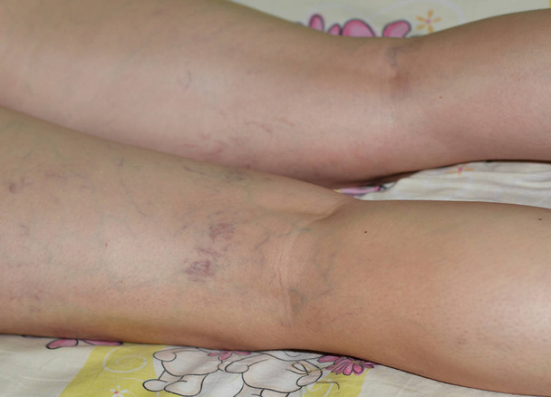 Varicose veins. Capillaries in the leg varicose veins. - Photo, Image