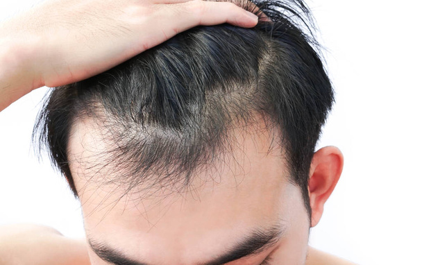 Jeune homme grave problème de perte de cheveux pour les soins de santé médical et shampooing concept de produit - Photo, image