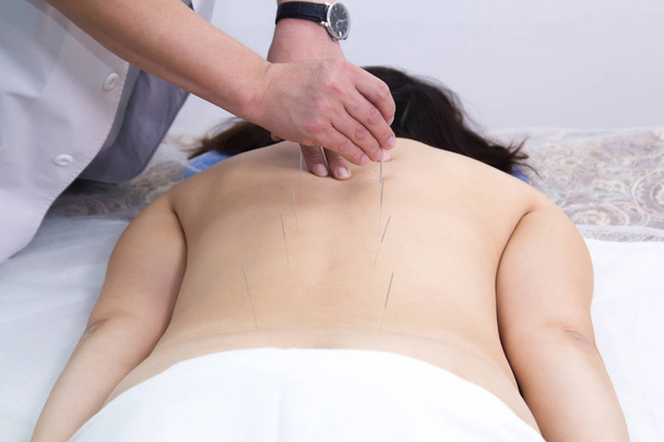 Młoda kobieta leczenia akupunktura. Wstawiania igły w plecy. Widok z tyłu - Zdjęcie, obraz