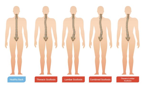 Infografica della curvatura spinale
 - Vettoriali, immagini